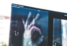 튼튼한 뼈를 위한 골다공증 예방, 지금 시작해야 합니다 citiscan result hand ok